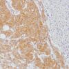 L-Kynurenine accumulation in human colorectal tumor by IHC