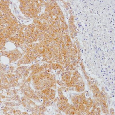 L-Kynurenine accumulation in human colorectal tumor by IHC