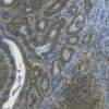 IHC validation of anti-3-Hydroxy-Anthranilic acid antibody in human colon tumor