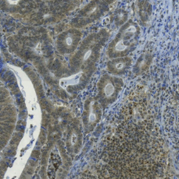 IHC validation of anti-3-Hydroxy-Anthranilic acid antibody in human colon tumor