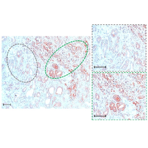 L-Glutamine antibody : IHC staining of frozen human pancreatic ductal adenocarcinoma tissues