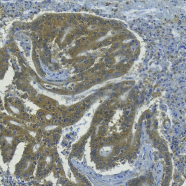 L-Kynurenine detection in human colon cancer tissue by IHC