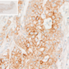 Immunohistochemical analysis reveals accumulation of L-Kynurenine within tumor cells of human colorectal cancer (CRC) tissue.