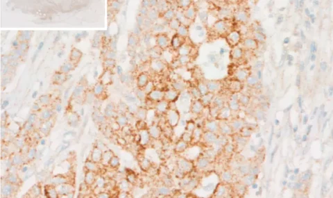 Immunohistochemical analysis reveals accumulation of L-Kynurenine within tumor cells of human colorectal cancer (CRC) tissue.