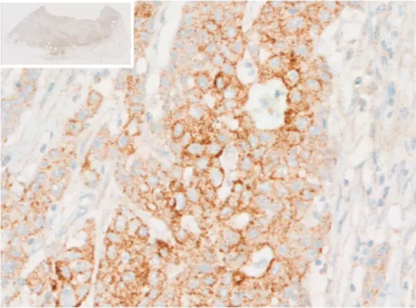 Immunohistochemical analysis reveals accumulation of L-Kynurenine within tumor cells of human colorectal cancer (CRC) tissue.