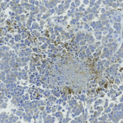 Cinnabarinic acid detection by IHC in human breast tumor
