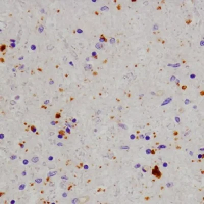 Quinolinic acid detection in human parkinson's brain