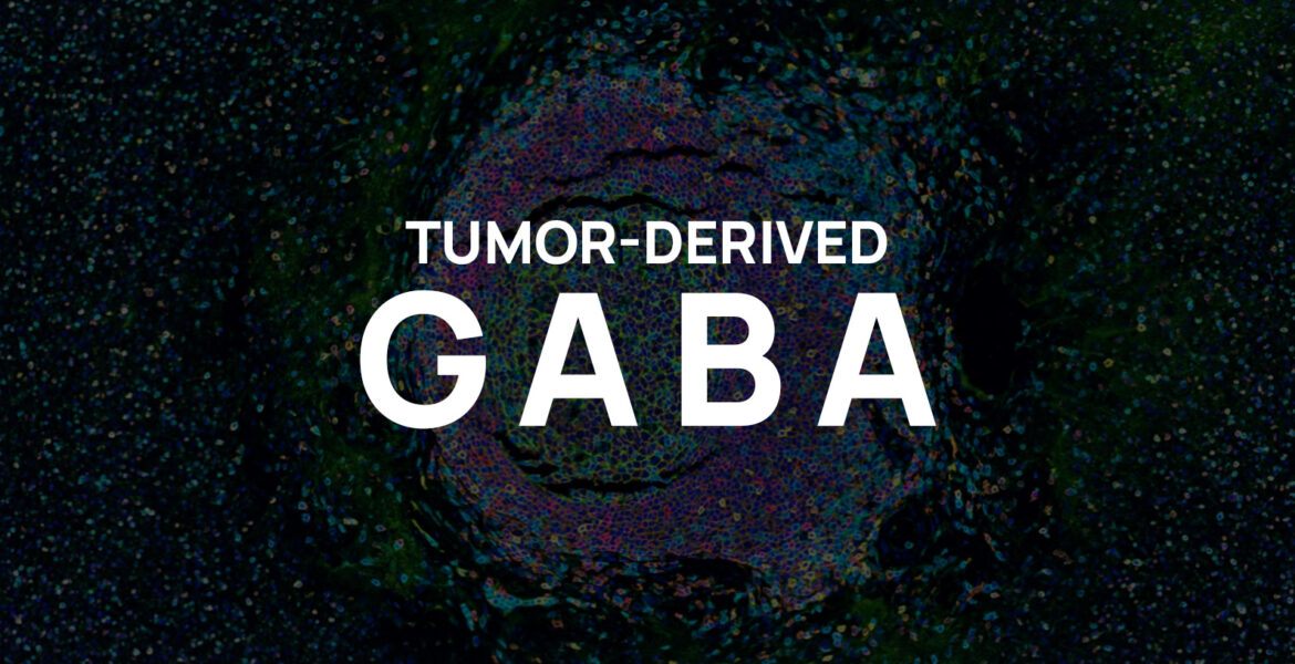 Tumor-derived GABA and resistance to immunotherapy in TLS-positive tumors